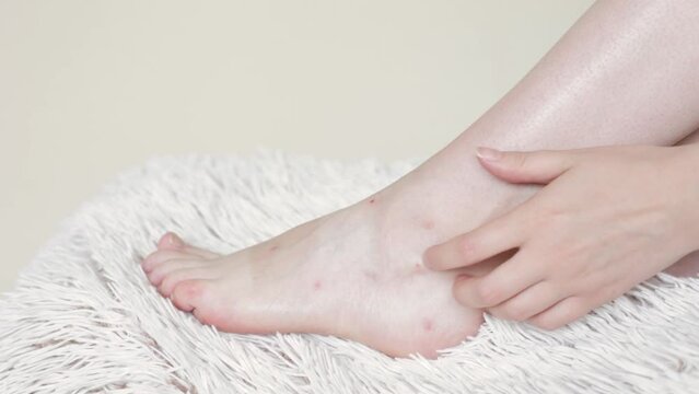 Women's hands scratch their feet and insect bites, mosquitoes and midges close up