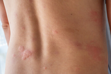 Young asian man itching and scratching on his back from allergic itchy dry skin eczema dermatitis insect bites