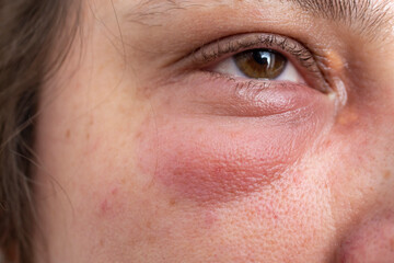 Obraz premium Swallen eye, external Chalazion or Hordeolum (Stye), on a Caucasian woman's eyelid