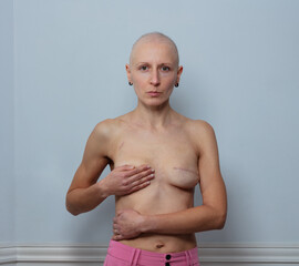 Bald person with scar from mastectomy is standing confidently
