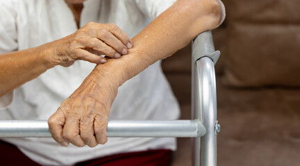 Elderly woman itchy and scratching arm because dry skin.