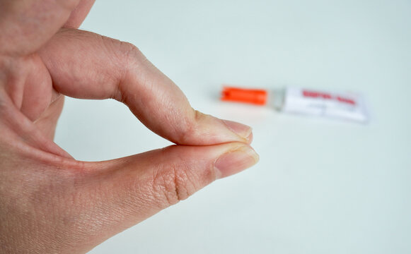 Human hand fingers glued together with strong adhesive super glue. Can not get super glue off the skin condition illustrative photography isolated on horizontal white background.