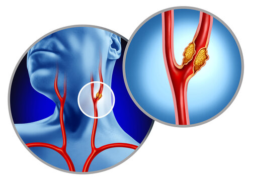Carotid Artery Disease as arteries bringing blood flow to the brain is interrupted by atherosclerosis as  plaque build up inside the blocked vessel causing narrowing or stenosis