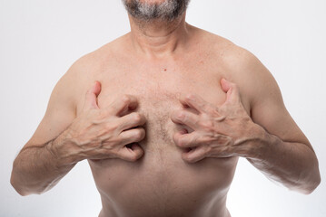 Naklejka premium Man, shirtless, scratching his chest. Allergic reaction. Skin disease. Dermatology.