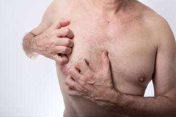 Naklejka premium Man, shirtless, scratching his chest. Allergic reaction. Skin disease. Dermatology.