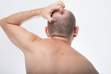 Naklejka premium Man, shirtless, scratching his head. Allergic reaction. Skin disease. Dermatology.
