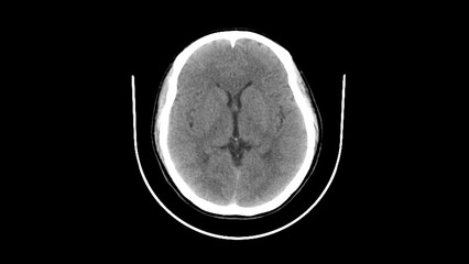 normal head ct scan brain window 