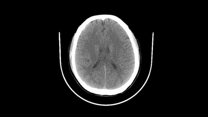 normal head ct scan brain window 