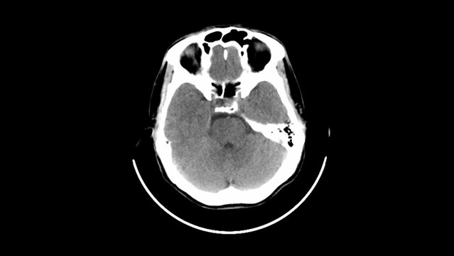 normal head ct scan brain window 