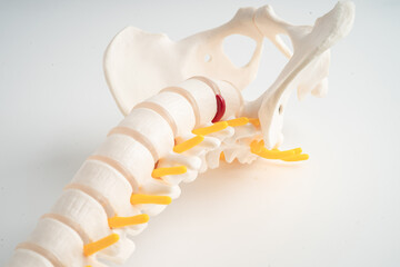 Lumbar spine displaced herniated disc fragment, spinal nerve and bone. Model for treatment medical...