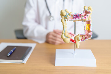 Doctor with human Colon anatomy model. Colonic disease, Large Intestine, Colorectal cancer,...