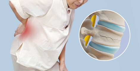 Back pain and spinal anatomy 3d illustration of elderly women_spinal compression fracture