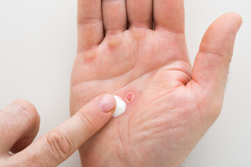 Young adult man finger applying white medical ointment on red callus on palm after work on light gray table background. First aid. Self help. Closeup. Point of view shot. Top down view.