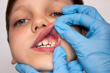 A dentist wearing medical gloves examines a child's oral cavity, close-up. Stomatitis or ulcers,...