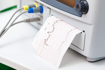 Cardiotocography CTG Fetal Heartbeat Monitoring Printout