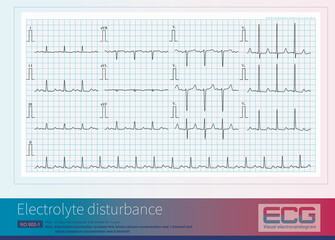 The presence of ST-segment prolongation and T wave symmetry and high tip on ECG suggests hypocalcemia and hyperkalemia.
