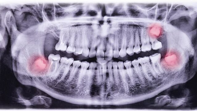 Wisdom teeth removal. Red flashing indicators for misaligned growth of wisdom teeth in a small jaw. A snapshot of the jaw.