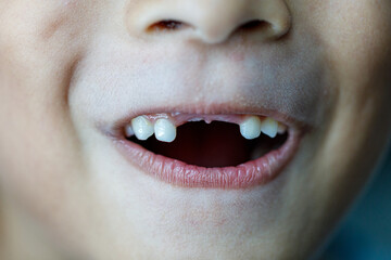 Close up image of the mouth of a little boy who just lost her two front teeth. New teeth are growing in where the old ones have fallen out