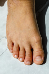 Top view of the foot and Brittle toenail causing nail surface layers or lamella to peel away with...
