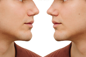 Obraz premium Before and after rhinoplasty surgery. Comparison rhinoplasty before plastic operation and result after to change shape of the nose. Septoplasty.