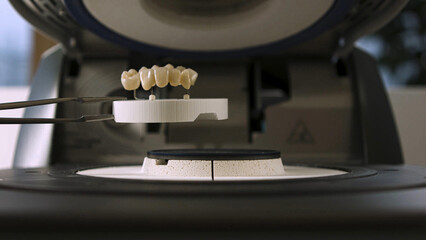 A dental technician is producing e-max and zirconium veneers. Glass-ceramic porcelains used for dental porcelain veneer treatment in dentistry. Laminate veneers and crown veneers.