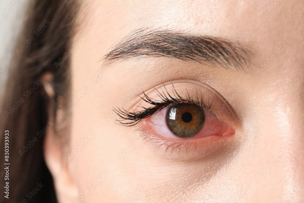 Wall mural Woman with red eye suffering from conjunctivitis, closeup