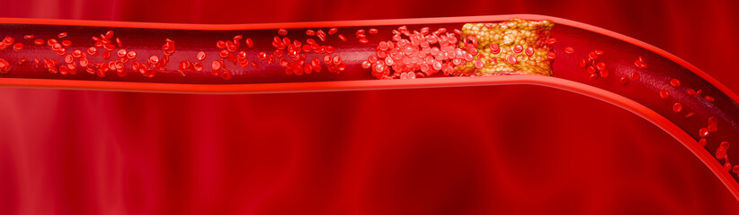 Hyperlipidemia or arteriosclerosis. Blocked artery concept and human blood vessel as a disease with cholesterol fat buildup clogging. Clogged arteries, Cholesterol plaque in the artery. 3D Rendering