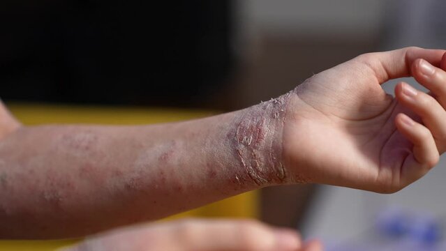 Close-up of a girl's hand diagnosed with atopic dermatitis