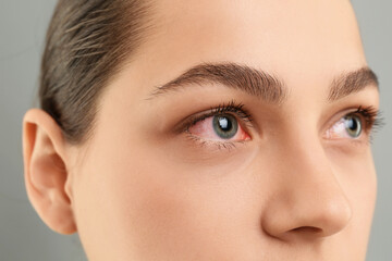 Woman with red eye suffering from conjunctivitis on grey background, closeup