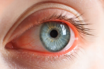 Woman with red eye suffering from conjunctivitis, closeup