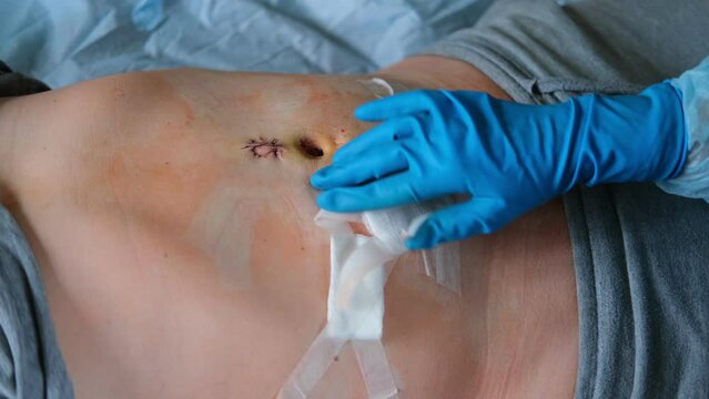 Hands of medic or nurse in blue gloves examining a fresh suture on a male stomach after laparoscopy surgical removal of appendicitis. Doctor examines of the patient. Man belly with medical stitches