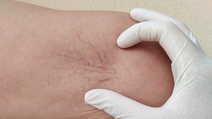 close up of an injection, stress and serious, problem circulation of blood, varicose veins on the leg of the middle aged women, health care and medical concept.