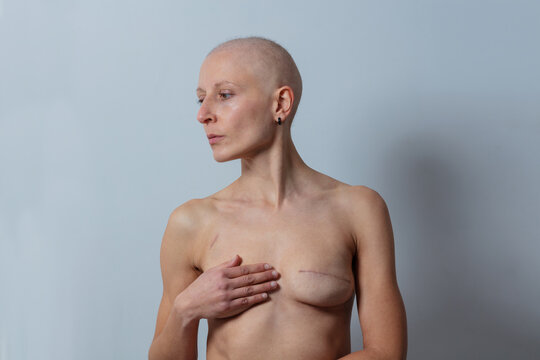 Courageous individual exhibits mastectomy scars and strength