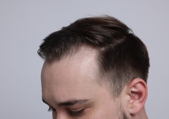 Baldness concept. Man with receding hairline on light grey background, closeup