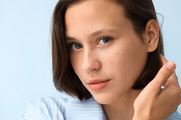 Beautiful young woman with acne problem on blue background