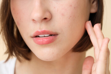 Obraz premium Beautiful young woman with acne problem on beige background, closeup