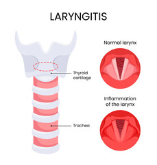 Diagram of laryngitis infection disease