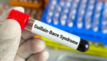 Obraz premium Guillain-Barre syndrome (GBS) test, a rare disorder where the body's immune system damages nerve.