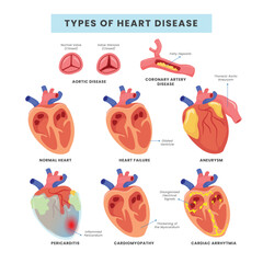 Set different Types of heart disease collection, vector illustration diagram. Educational medical information, coronary artery disease or aortic disease, vector illustration.