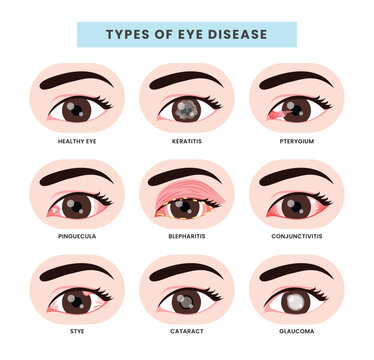 Set of different types of eye disease collection, Ophthalmology health illustration with Keratitis, pterygium, pingueculum, blepharitis, conjunctivitis, stye, cataract, glaucoma. vector illustration.