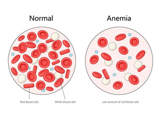 normal blood cells with anemic blood cells, highlighting the low amount of red blood cells in anemia diagram hand drawn schematic vector illustration. Medical science educational illustration