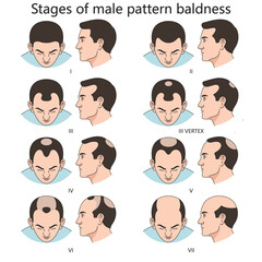 Stages of male pattern baldness, showing progressive hair loss from stage I to stage VII diagram hand drawn schematic vector illustration. Medical science educational illustration