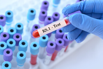 Fototapeta premium Doctor holding a test blood sample tube for the detection of the virus KS.1 on the background of medical test tubes. KS.1 one of the FliRT variants. Symptoms with FLiRT are the same as with omicron