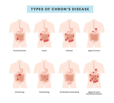 Set of different types of Crohn's disease anatomy classification,  inflammatory bowel disease with terminal ileum, colon,ilecolon, upper gi tract, stricturing,medical infographic banner for education.