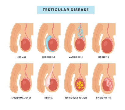 Different types of Testicular diseases types scheme male anatomy medical inflammation, Internal organ penis urologic health varicocele epididymitis orchitis spermatocele testis torsion hidrocele.