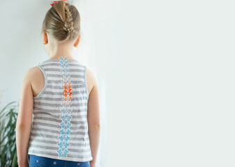back little girl with scoliosis, child 5 years old crookedly standing, spine deformity curved,...