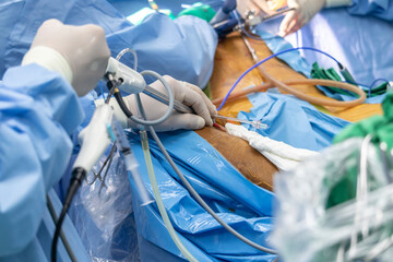 Close up group of surgeons Critical Limb Ischemia operating room. The medical team of surgeons...