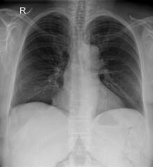 x ray image of human chest 