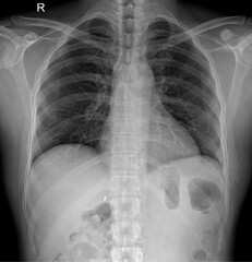 Professional X-ray Scan of Human Ribcage and Respiratory System