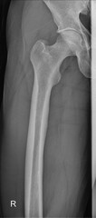 Advanced X-ray Scan of Human Femur and Thigh Bones